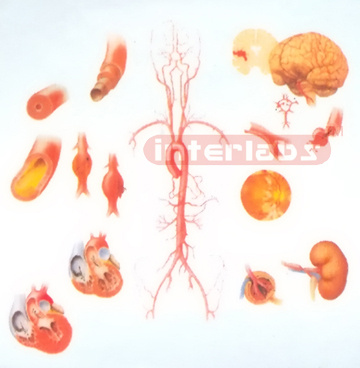 HANGING HUMAN HYPERTENSION DISEASE MODEL FOR DESCRIPTION AND DEMONSTRATION